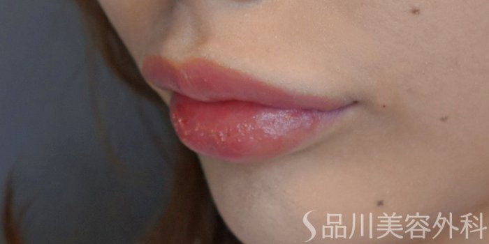 症例NO.71474のAFTER写真