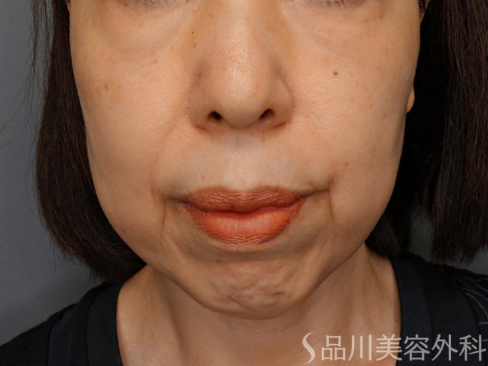 症例NO.74372のBEFORE写真