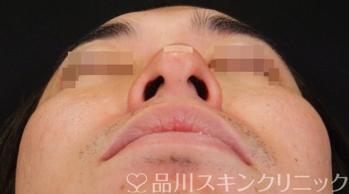 症例NO.65965のAFTER写真