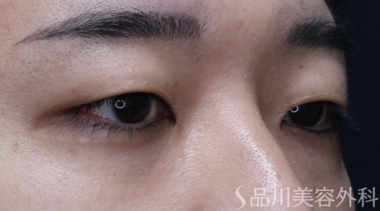 症例NO.71507のBEFORE写真