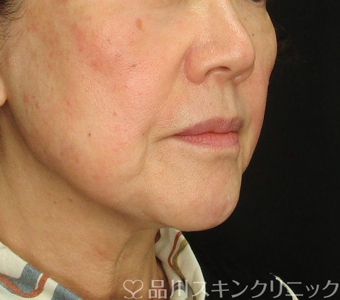 症例NO.73884のBEFORE写真