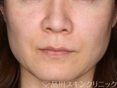 症例NO.73915のBEFORE写真