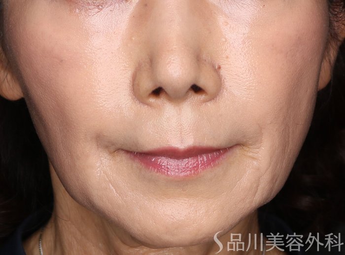 症例NO.72379のAFTER写真