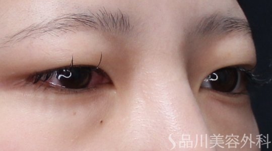 症例NO.73617のBEFORE写真