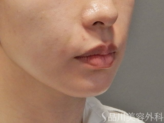 症例NO.74654のAFTER写真