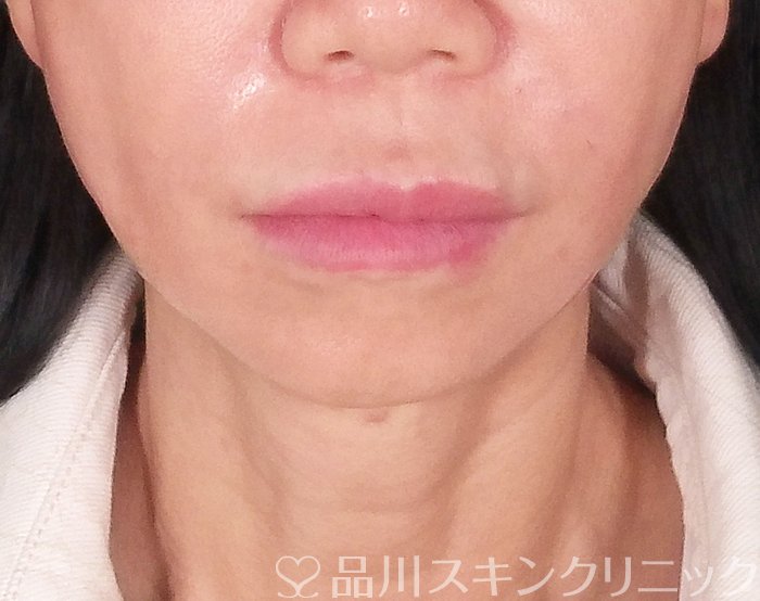症例NO.70120のAFTER写真