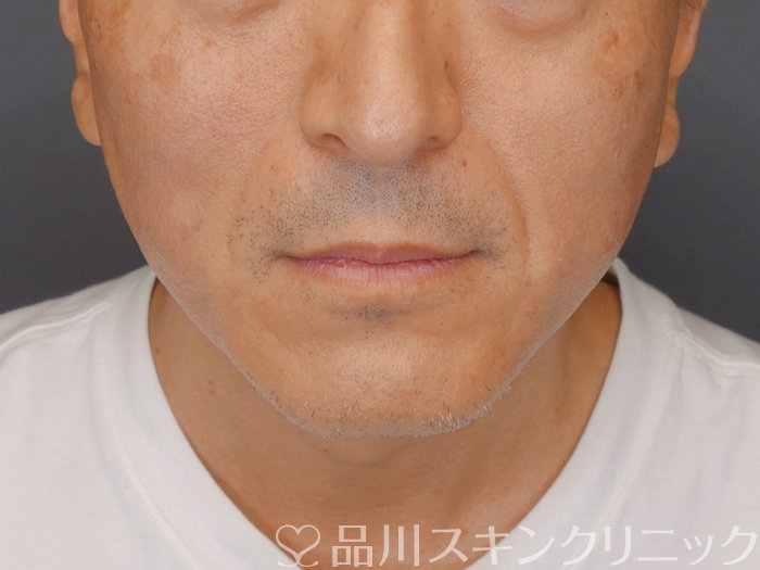 症例NO.71089のAFTER写真