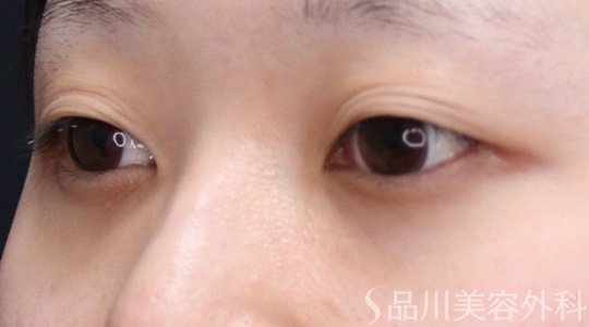 症例NO.70006のBEFORE写真
