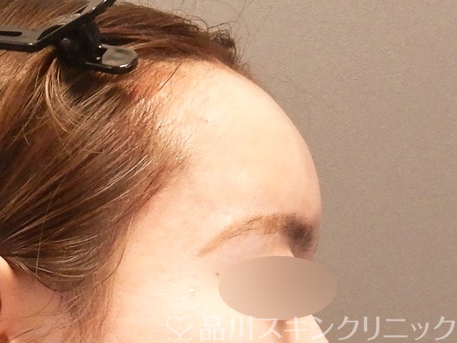 症例NO.70114のAFTER写真