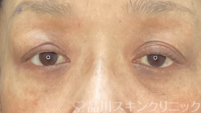 症例NO.71421のAFTER写真
