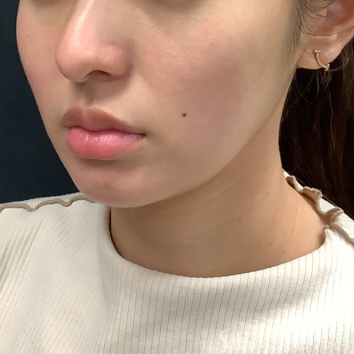 症例NO.75326のBEFORE写真
