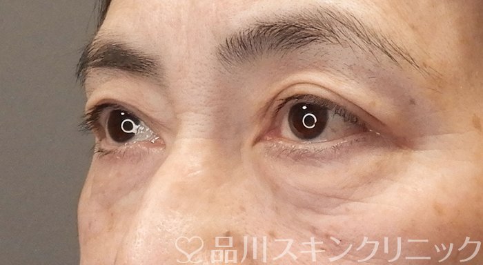 症例NO.70629のAFTER写真