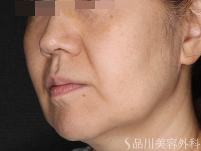 症例NO.71254のBEFORE写真