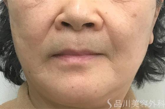 症例NO.54932のAFTER写真
