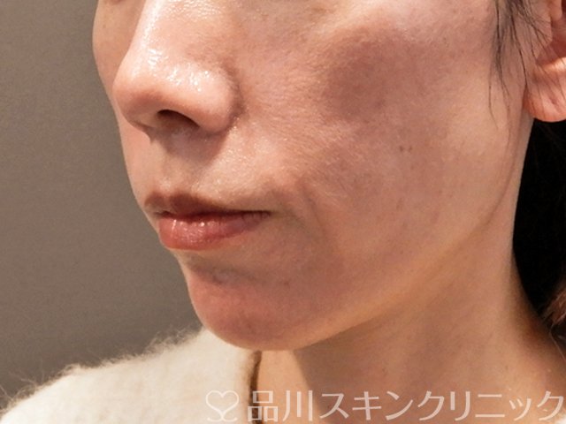 症例NO.69825のBEFORE写真