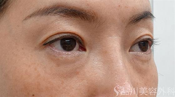 症例NO.47778のBEFORE写真