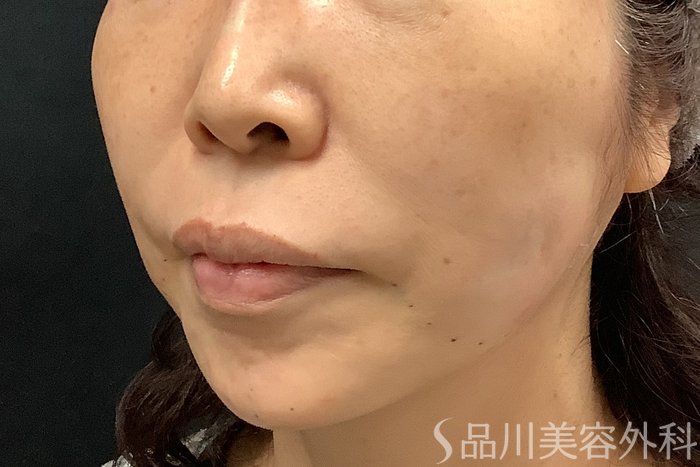 症例NO.71257のAFTER写真