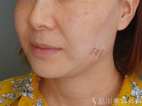 症例NO.51282のAFTER写真