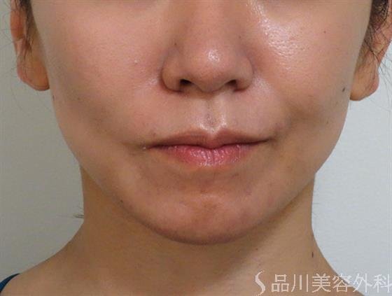 症例NO.39106のAFTER写真