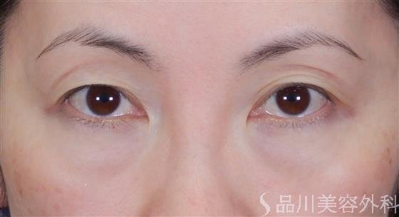 症例NO.60039のBEFORE写真
