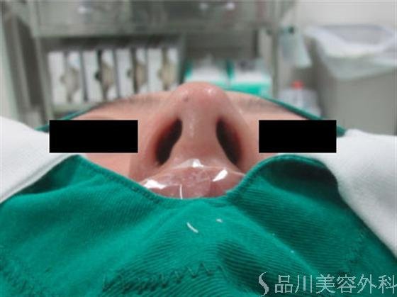 症例NO.6861のAFTER写真