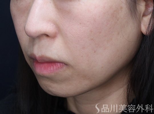 症例NO.74124のBEFORE写真