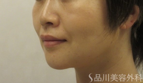 症例NO.74074のAFTER写真
