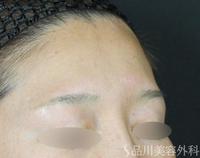 症例NO.71134のBEFORE写真