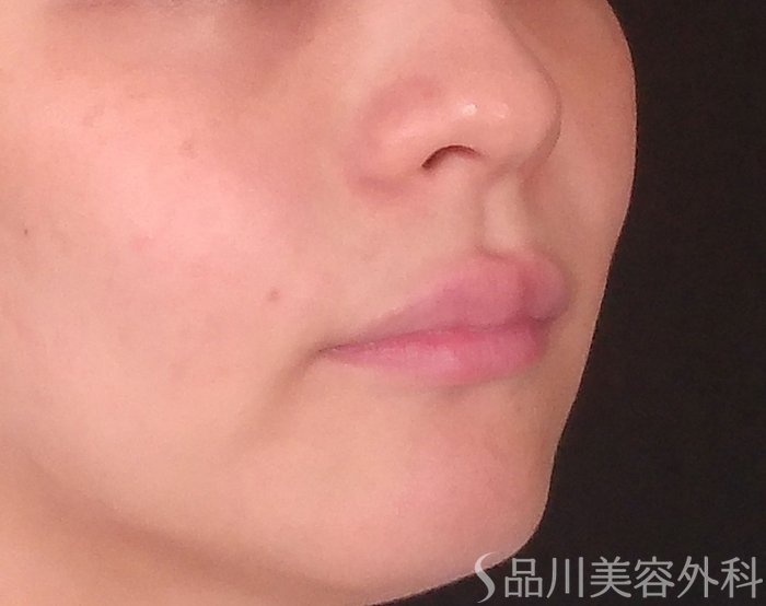 症例NO.70525のBEFORE写真