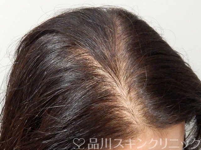症例NO.68421のAFTER写真