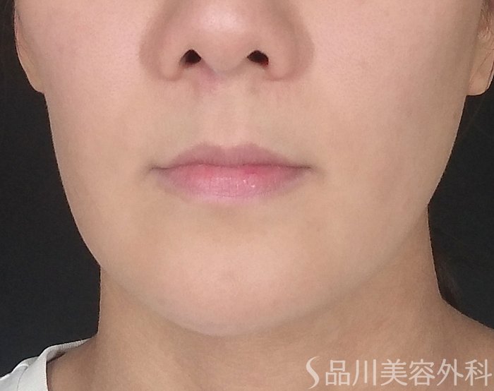 症例NO.69857のBEFORE写真