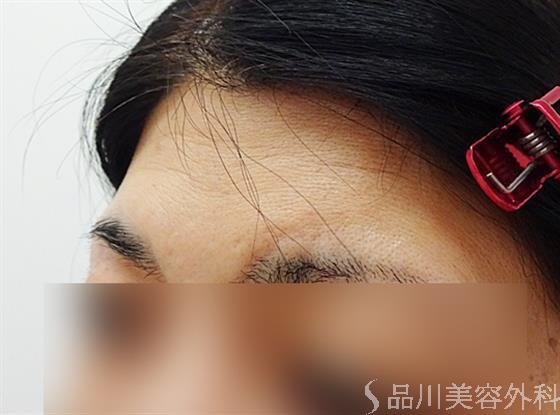 症例NO.36143のBEFORE写真