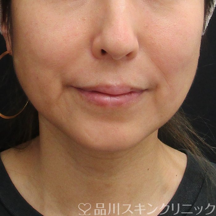 症例NO.74953のBEFORE写真