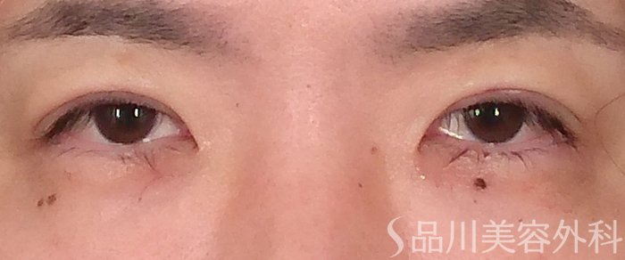 症例NO.70417のAFTER写真