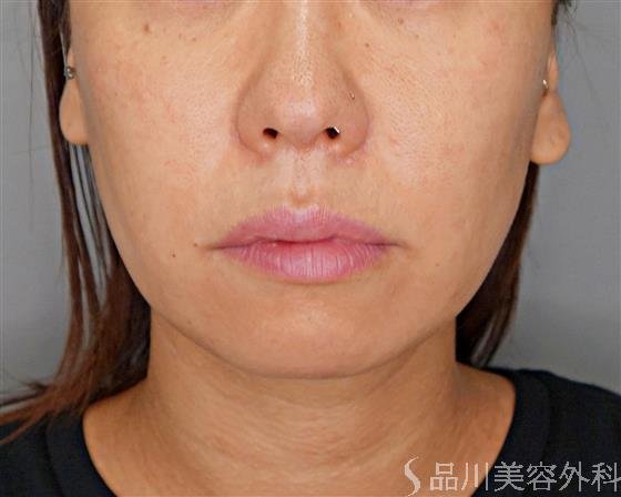 症例NO.52486のBEFORE写真
