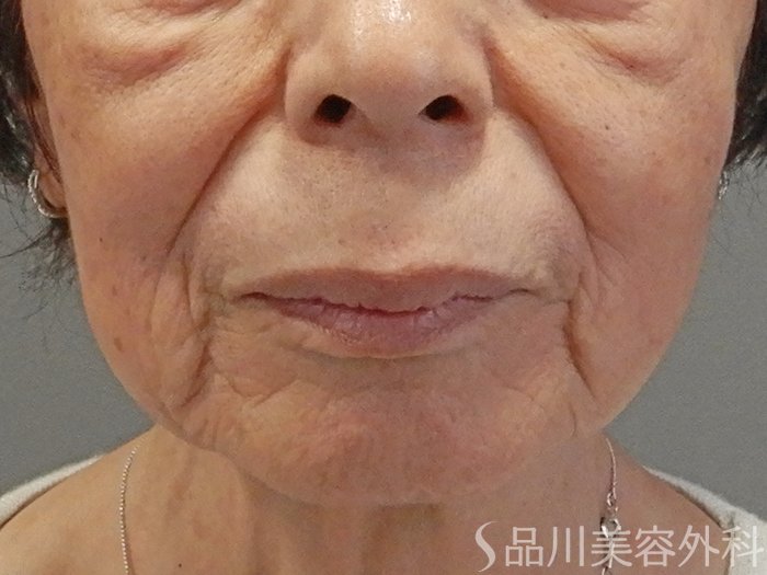 症例NO.70358のBEFORE写真