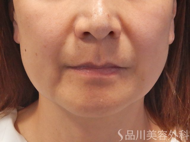 症例NO.72335のBEFORE写真