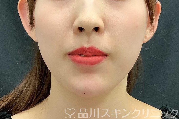 症例NO.69705のAFTER写真