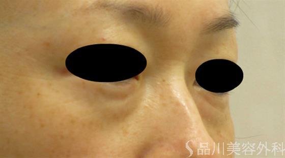 症例NO.57960のBEFORE写真