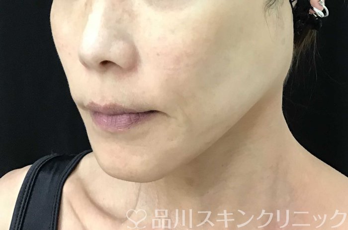 症例NO.71108のAFTER写真