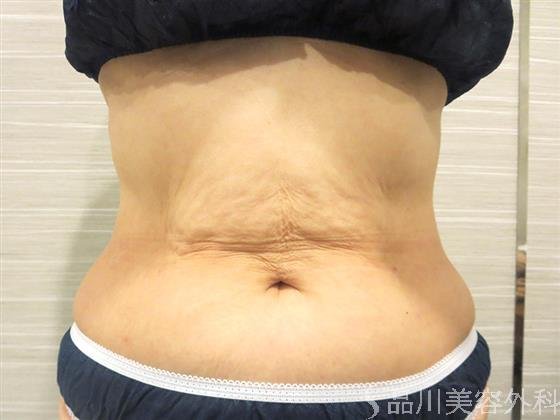 症例NO.20827のAFTER写真