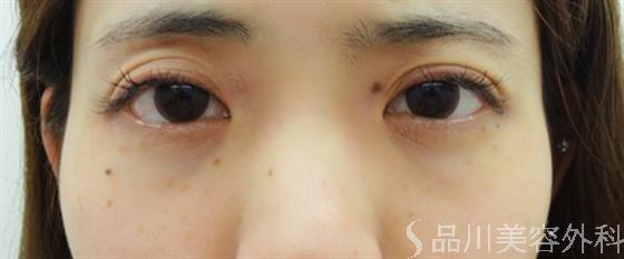 症例NO.30381のBEFORE写真