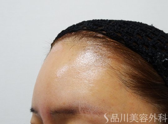 症例NO.69637のBEFORE写真