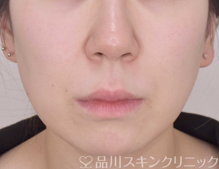 症例NO.69738のBEFORE写真