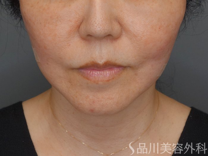 症例NO.72942のAFTER写真