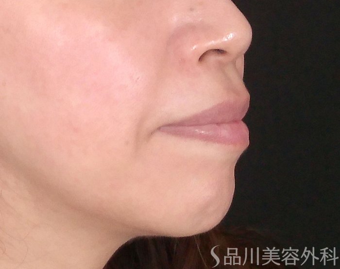 症例NO.70320のBEFORE写真