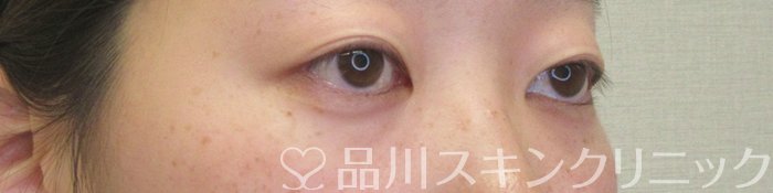 症例NO.74203のBEFORE写真