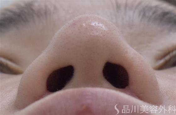 症例NO.47696のAFTER写真