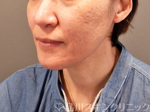 症例NO.69748のBEFORE写真