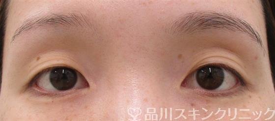 症例NO.42340のBEFORE写真